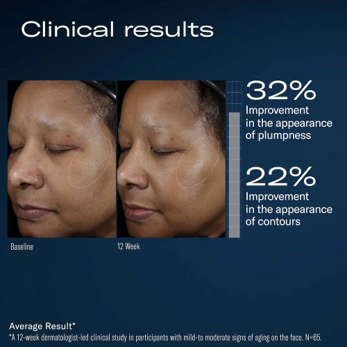SkinBetter Science Ampra Volumizing Macro HA Serum 1 fl oz before and after