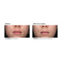 PCA Skin Acne Gel 1fl oz. - results