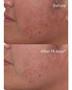 Murad Rapid Dark Spot Correcting Serum - SkinElite - before and after 1