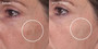 Murad Rapid Dark Spot Correcting Serum - SkinElite - before and after 2