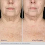 Obagi ELASTIderm Neck and Decollete Concentrate 2 fl oz before and after 2