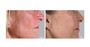 AnteAGE MD Biosome System Before and After Example 1 - Skin Elite AnteAGE MD Biosome System Before and After Example 1 - Skin Elite