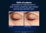 PCA Skin Microneedle Eye Patches - set of 4 - SkinElite - before and after 2 PCA Skin Microneedle Eye Patches - set of 4 - SkinElite - before and after 2