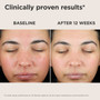 EltaMD UV Skin Recovery Sunscreen Before and After Showing Reduced Redness EltaMD UV Skin Recovery Sunscreen Before and After Showing Reduced Redness