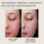 eltamd-post-procedure-bundled-kit-uv-skin-recovery-green-tint-color-corrector-spf50-before-after