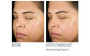 SkinBetter Even Intensive Skin Tone Correcting Serum before and after 1