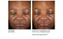 SkinBetter Even Intensive Skin Tone Correcting Serum before and after 2