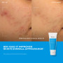 Murad Clear Skin Acne Discovery kit before and after 2