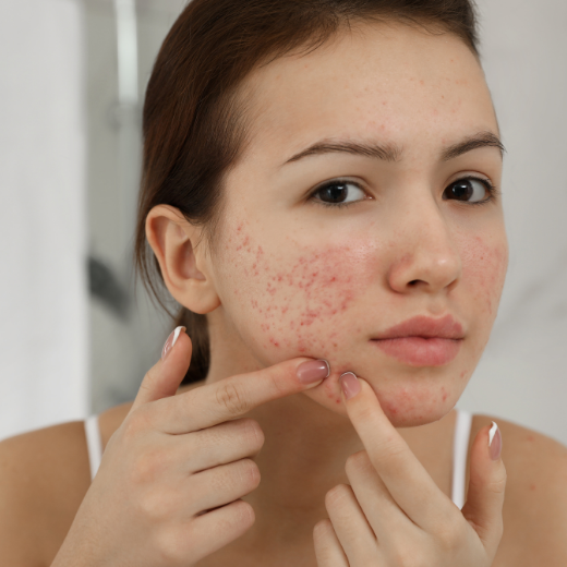 Skin 911! What to Do (and What Not to Do) for an Acne Breakout