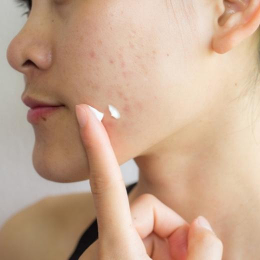 Most Common Mistakes in Treating Adult Acne