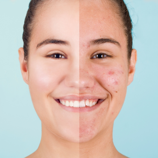 How to Conquer the Battle Against Deep Cystic Acne