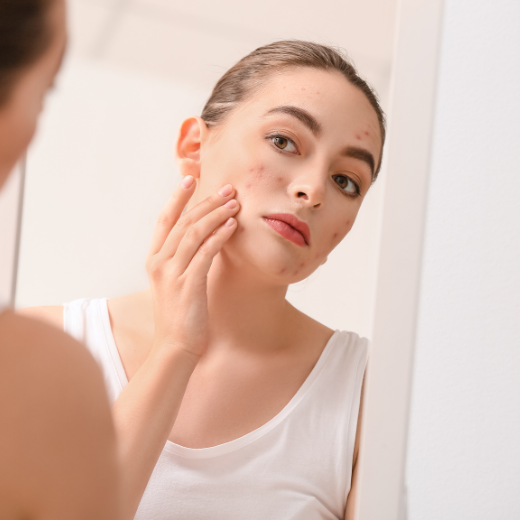 How to Manage Adult Acne: 7 Top Tips