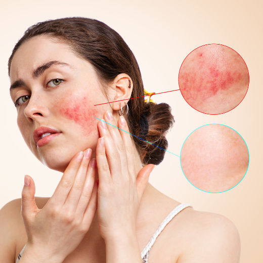 Adult Acne or Rosacea: How Can You Tell?