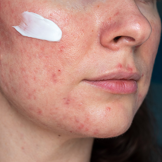 Why Am I Blushing? Common Rosacea Triggers and How to Minimize Them