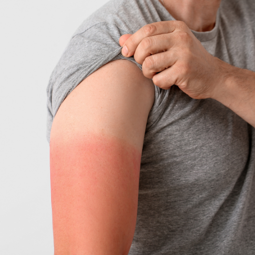 I Got A Sunburn! Now What? How to Care for Sunburned Skin