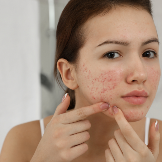 Skin Care for Parents - How to Help Your Teen with Their Acne