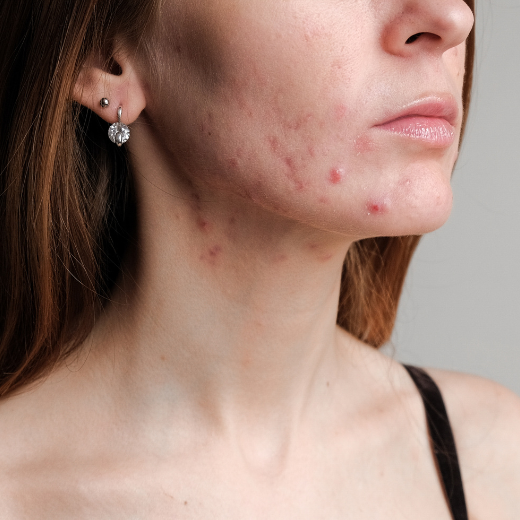 Stopping Birth Control Heres How To Manage Post Pill Acne Skin Elite