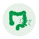 Diverticulosis