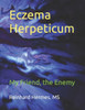 Eczema Herpeticum: My Friend, the Enemy