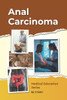 Anal Carcinoma