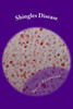 Shingles Disease: The Complete Guide