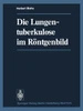 Die Lungentuberkulose Im Röntgenbild