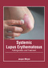 Systemic Lupus Erythematosus: Pathogenesis and Treatment