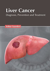 Liver Cancer: Diagnosis, Prevention and Treatment Liver Cancer: Diagnosis, Prevention and Treatment