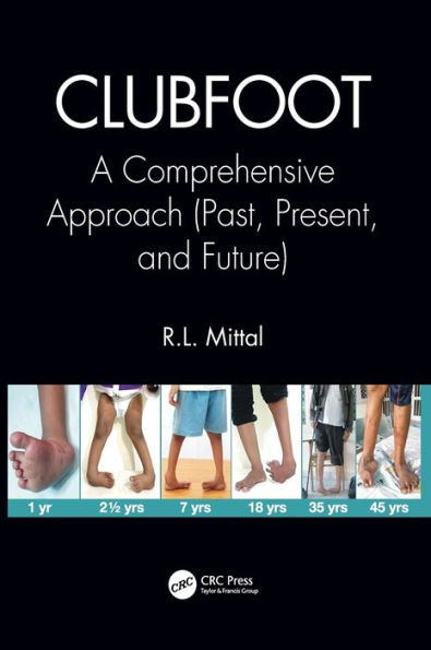 Clubfoot: A Comprehensive Approach (Past, Present, and Future)