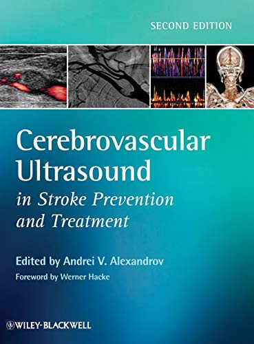 Cerebrovascular Ultrasound In Stroke Prevention And Treatment