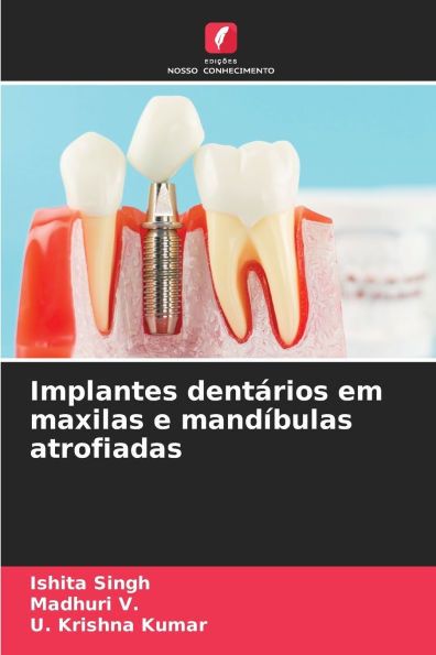 Implantes dentÃ¡rios em maxilas e mandÃ­bulas atrofiadas