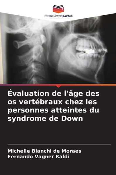 Évaluation de l'âge des os vertébraux chez les personnes atteintes du syndrome de Down