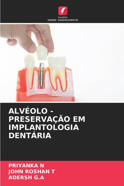 AlvÃ©olo - PreservaÃ§Ã£o Em Implantologia DentÃ¡ria