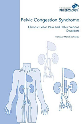 Pelvic Congestion Syndrome - Chronic Pelvic Pain and Pelvic Venous Disorders