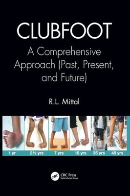Clubfoot: A Comprehensive Approach (Past, Present, and Future)