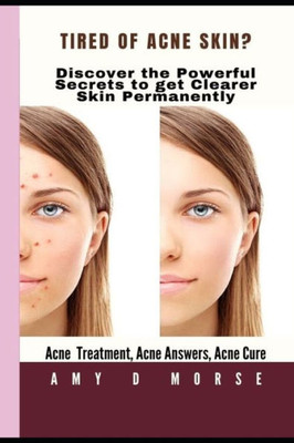 Tired Of Acne Skin? Discover The Powerful Secrets To Get Clearer Skin Permanently