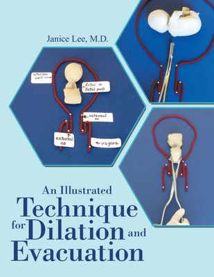 An Illustrated Technique For Dilation And Evacuation