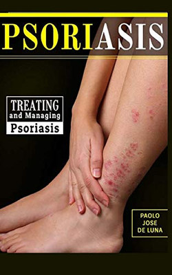 Psoriasis: Treating and Managing Psoriasis
