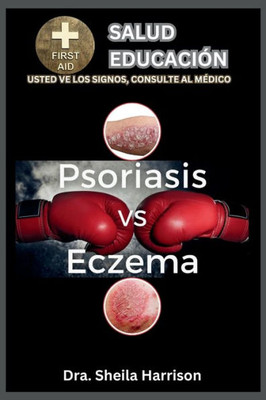 Psoriasis vs. Eczema: Diferencias, Similitudes, Tipos, SÃ­ntomas, Causas, DiagnÃ³stico, Tratamiento, Medicamentos, PrevenciÃ³n y Control, Manej