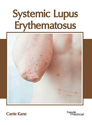 Systemic Lupus Erythematosus