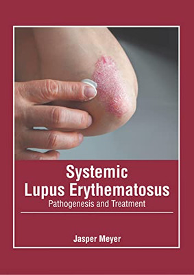 Systemic Lupus Erythematosus: Pathogenesis and Treatment