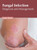 Fungal Infection: Diagnosis and Management