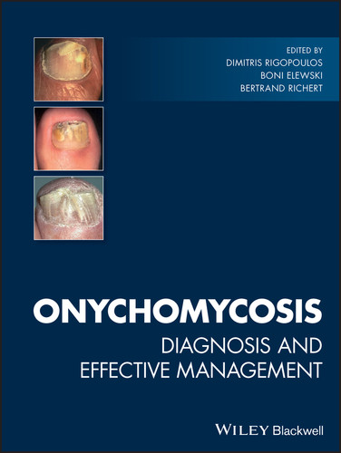 Onychomycosis: Diagnosis and Effective Management book cover by 