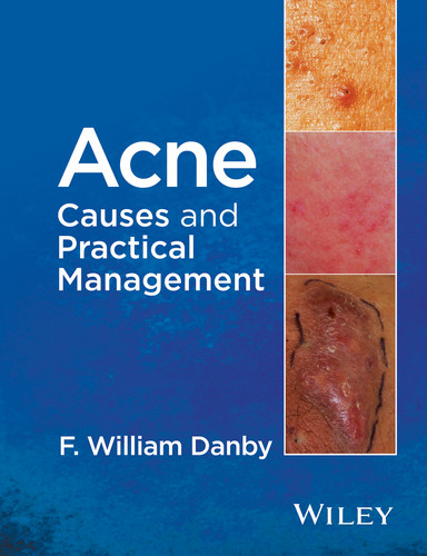 Acne: Causes and Practical Management book cover by F. William Danby