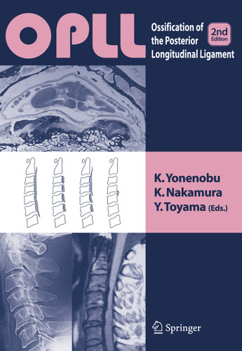 OPLL: Ossification of the Posterior Longitudinal Ligament book cover by 