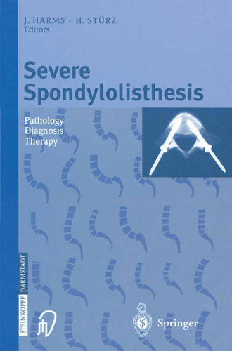Severe Spondylolisthesis: Pathology - Diagnosis - Therapy book cover by 