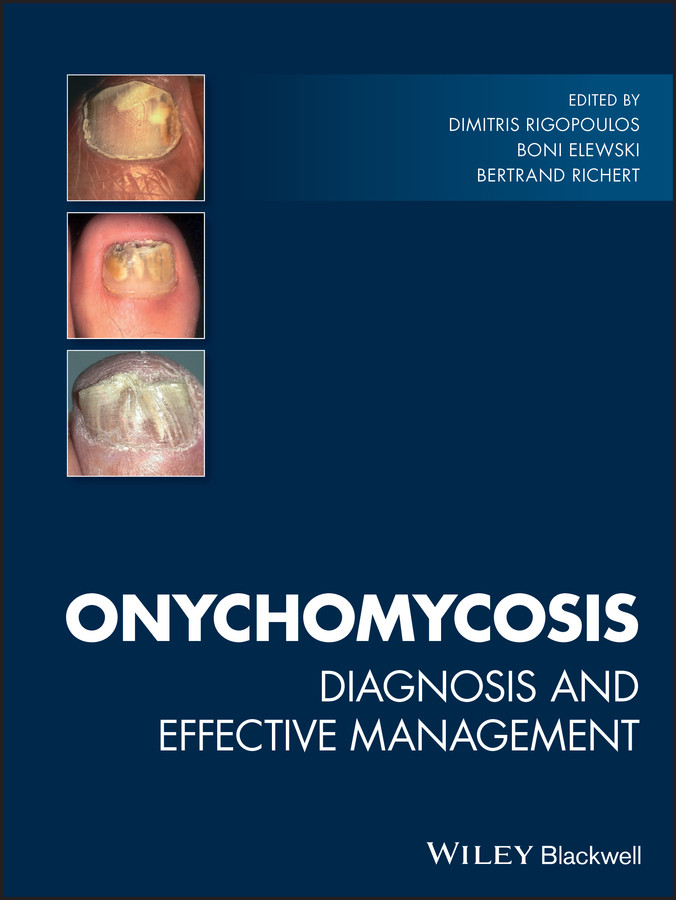 Onychomycosis: Diagnosis and Effective Management book cover by 