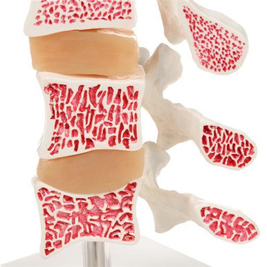 3B Scientific Deluxe Human Osteoporosis Model (3 Vertebrae with Discs ), Removable on Stand Smart Anatomy