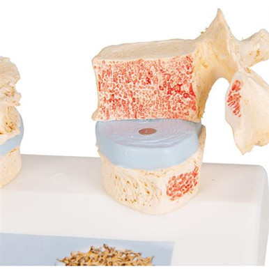 3B Scientific Osteoporosis Didactic Model Smart Anatomy
