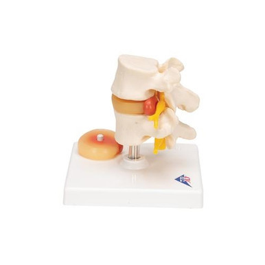 3B Scientific Human Lumbar Spinal Column with Prolapsed Intervertebral Disc - 3B Smart Anatomy